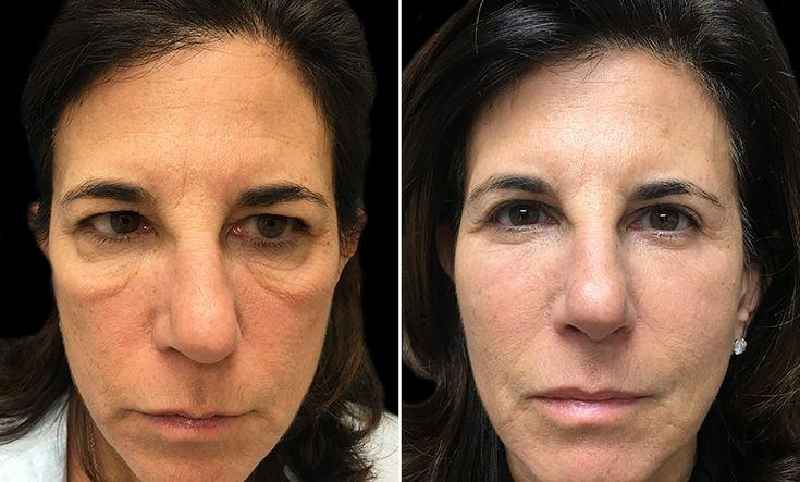 Do fillers remove wrinkles
