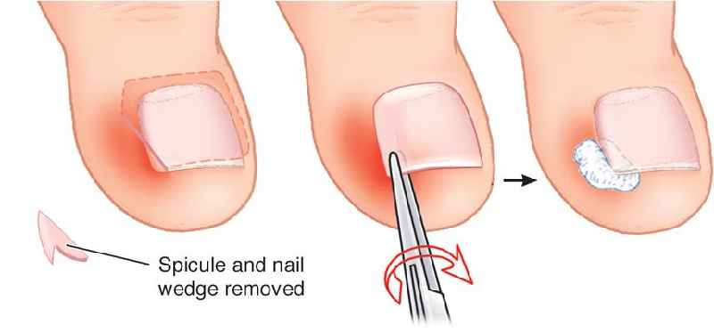 Do hospitals remove ingrown toenails