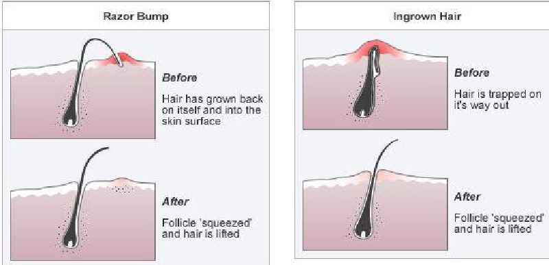 Do ingrown hairs have pus