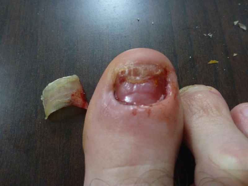 Do ingrown toenails go away on there own