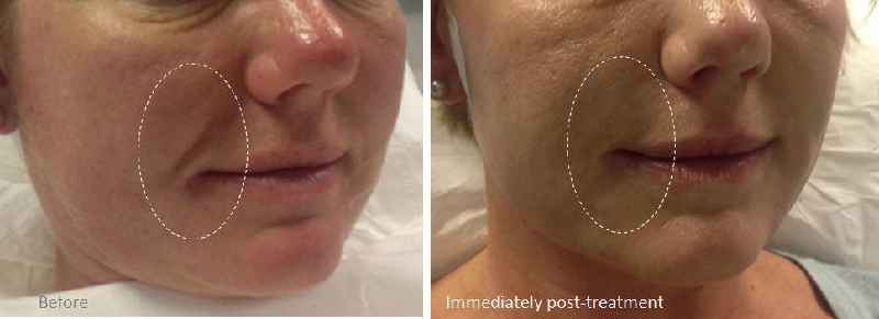 Do non surgical facelifts work