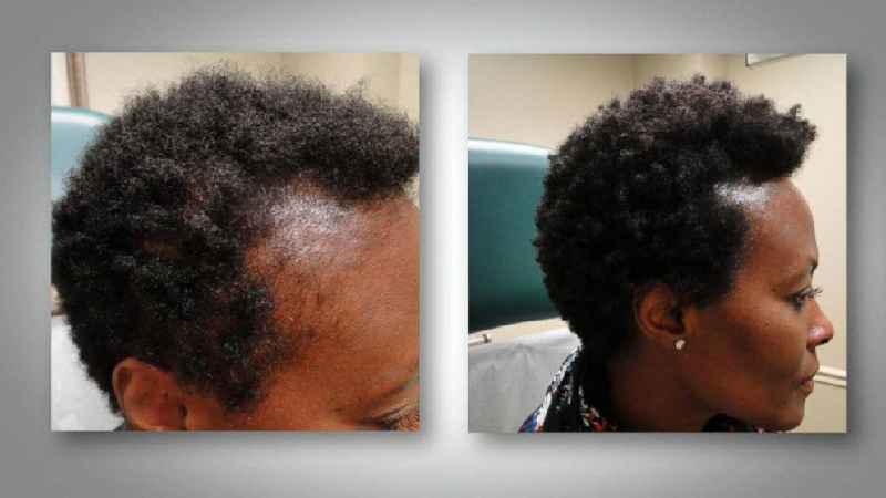 Do scalp injections work for hair loss