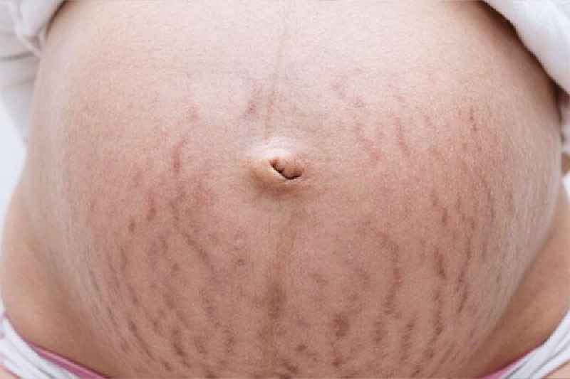 Do stretch marks mean loose skin