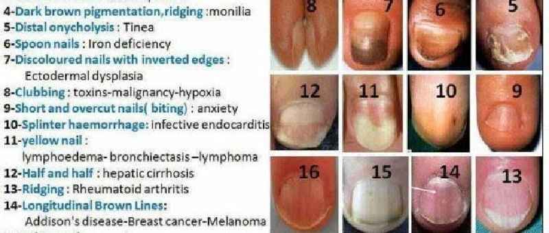 Do thyroid problems cause nail ridges
