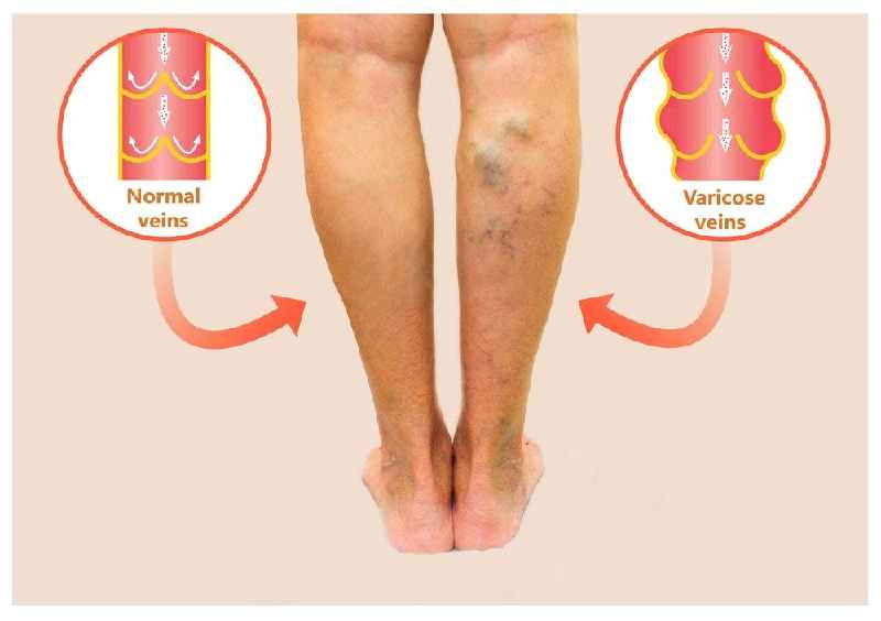 Do varicose veins come back after surgery
