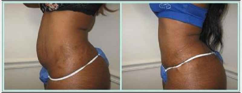 Do you have drain tubes after a tummy tuck
