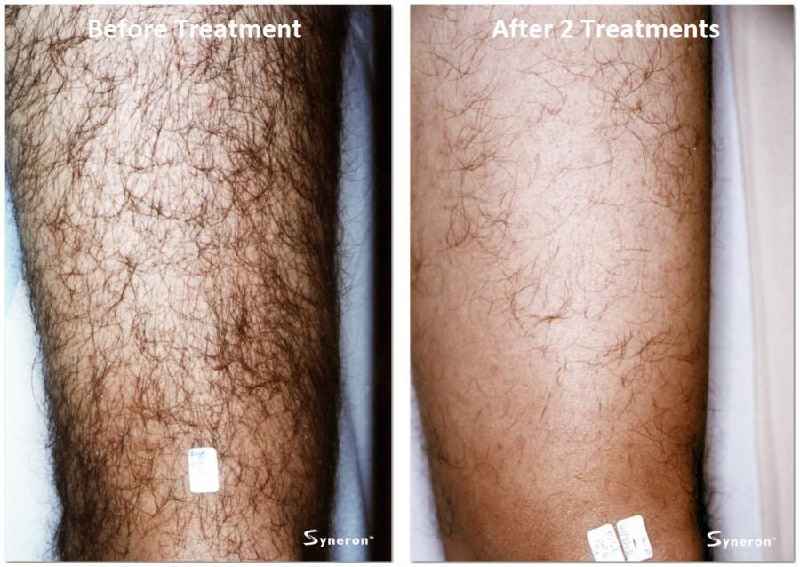 Do you see a difference after first laser hair removal