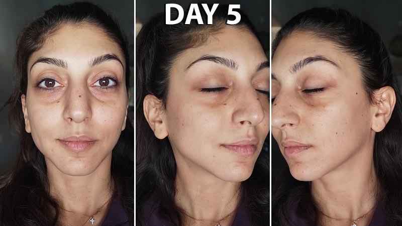 Do you see results after one session of Microneedling