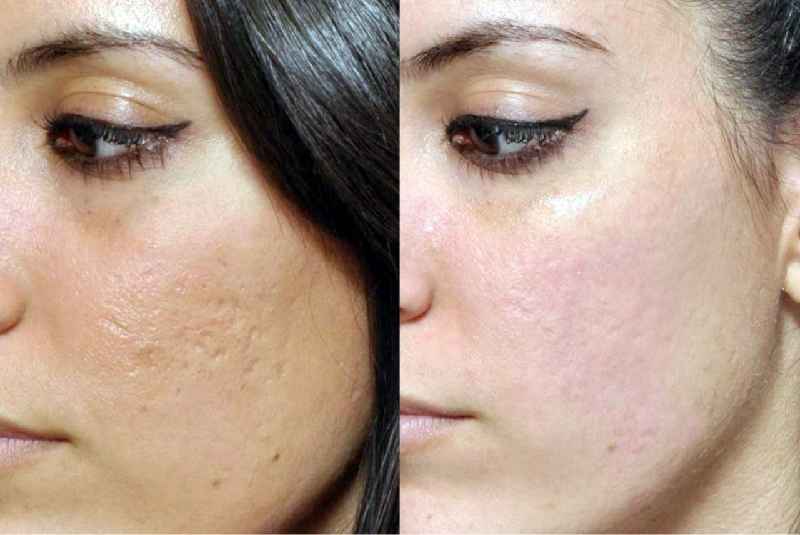 Do you see results after one session of Microneedling