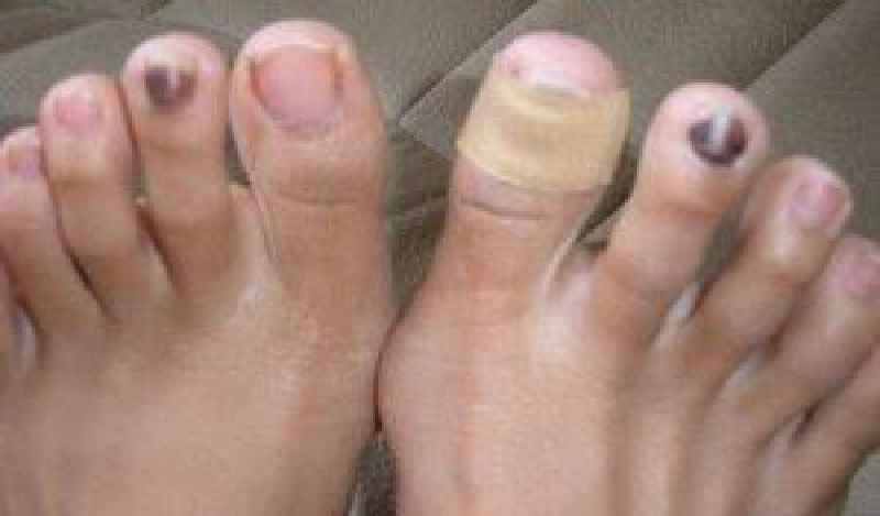 Does a bruised toenail always fall off