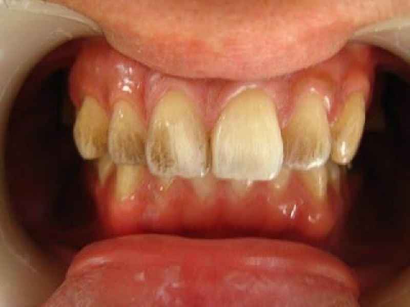 Does a hygienist whiten teeth