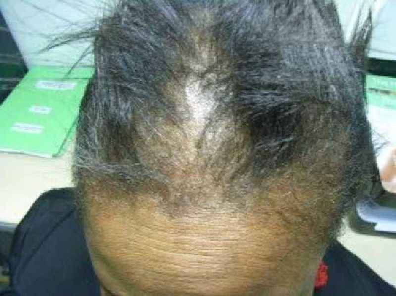 Does a lack of vitamin D cause hair loss