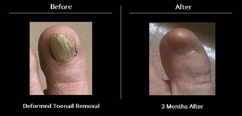 Does a scab form after toenail removal