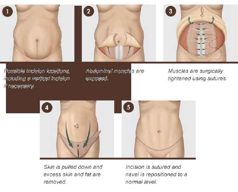 Does a tummy tuck help your butt