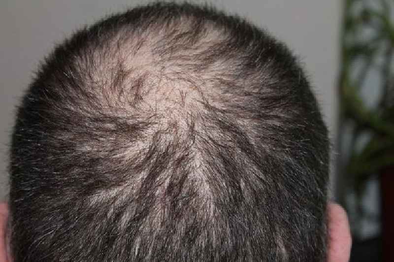 Does a vitamin D deficiency cause hair loss