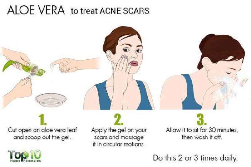 Does aloe vera help acne