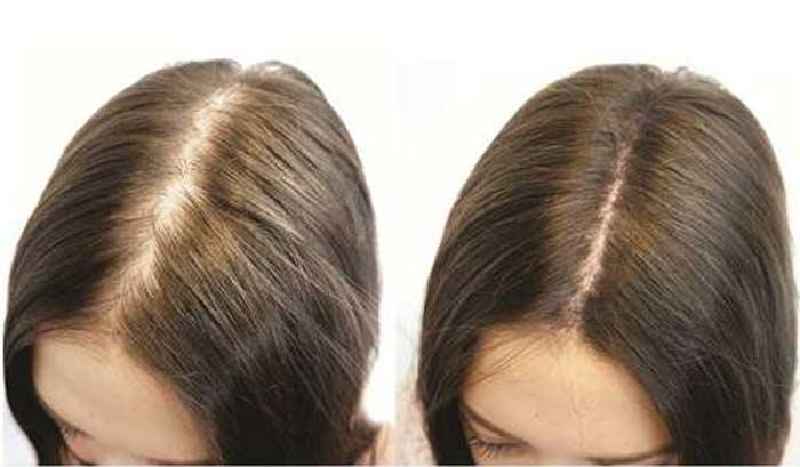Does biotin help hairloss