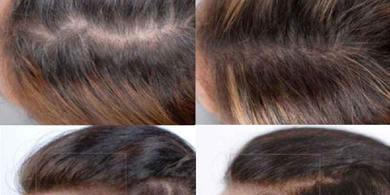 Does biotin stop hair loss