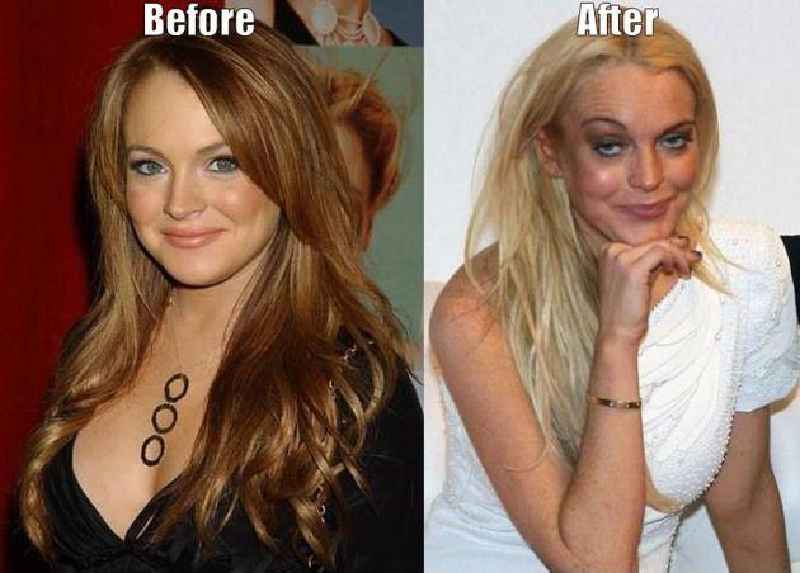 Does Botox change your expression