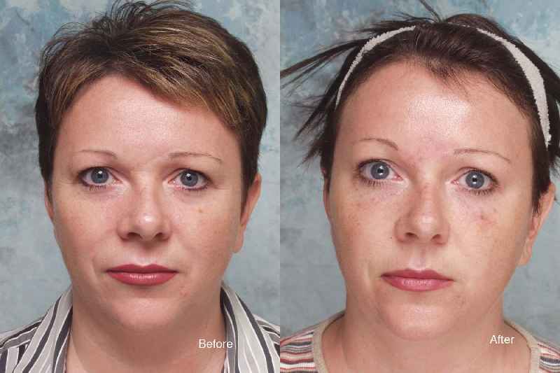 Does Botox help dark circles under eyes