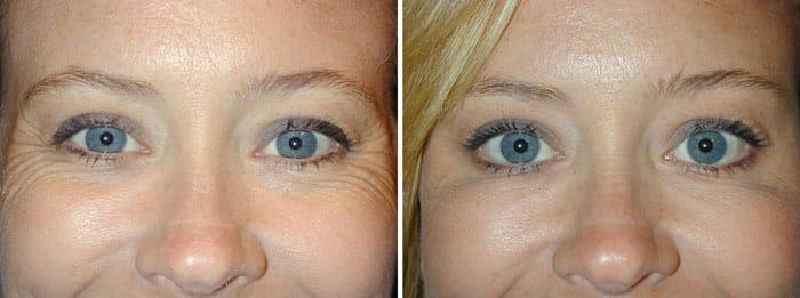 Does Botox remove bags under eyes