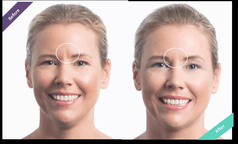 Does Botox work on deep wrinkles