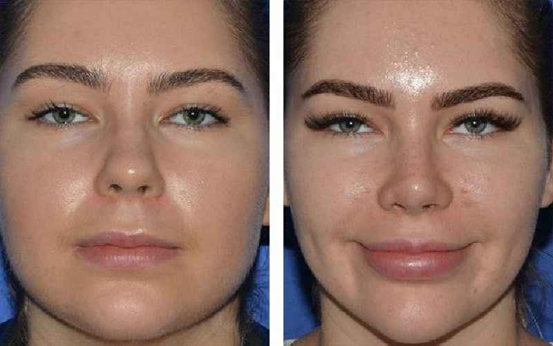 Does buccal fat removal make a difference