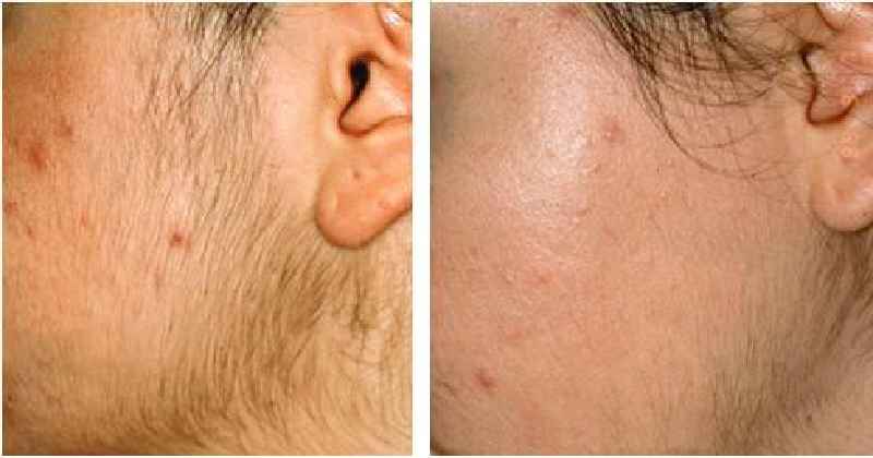 Does chin laser hair removal hurt