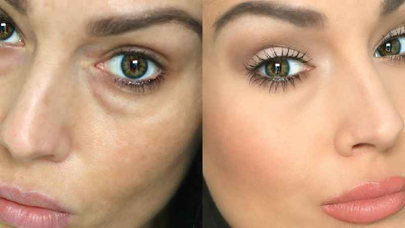 Does CO2 laser help with under eye bags