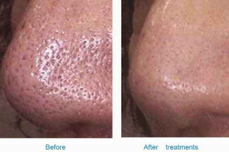 Does CO2 laser reduce pore size