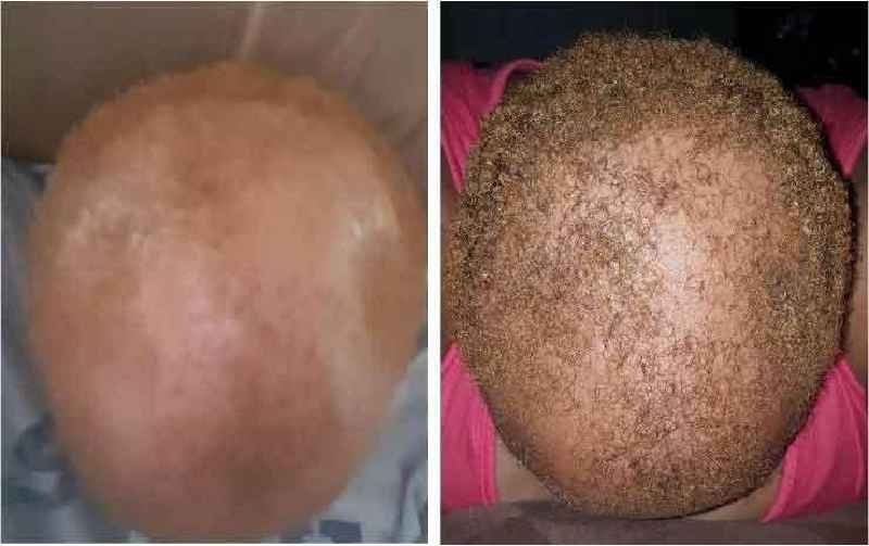 Does coconut oil help postpartum hair loss