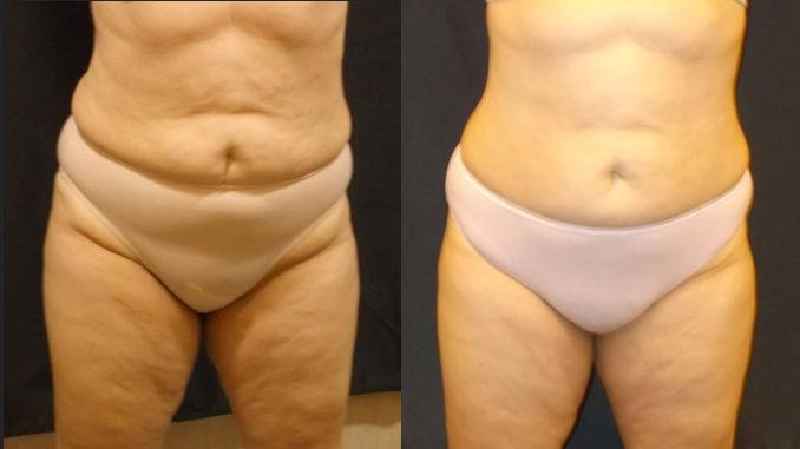 Does CoolSculpting leave saggy skin