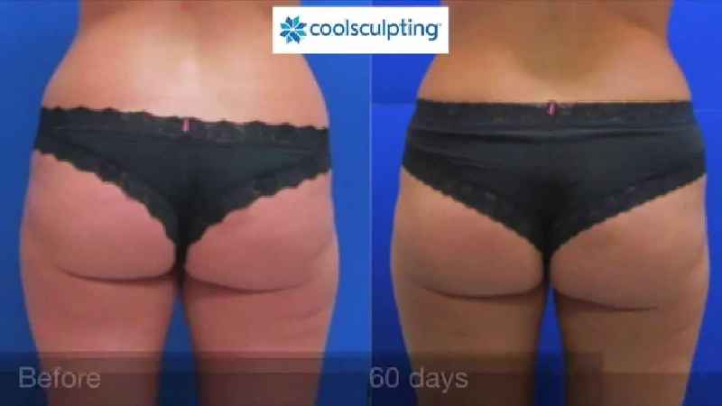Does CoolSculpting make cellulite worse