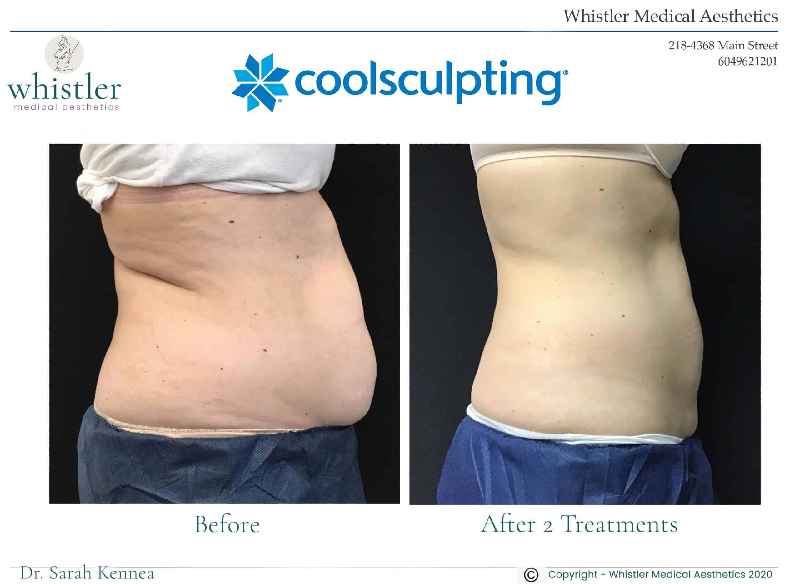 Does CoolSculpting work chin