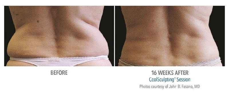 Does CoolSculpting work for love handles