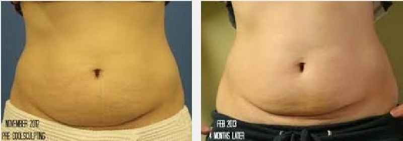 Does CoolSculpting work on belly fat