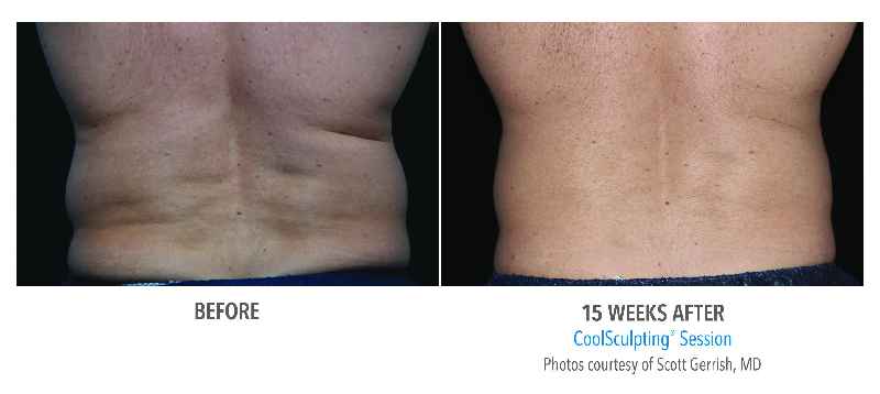 Does CoolSculpting work on inner thighs