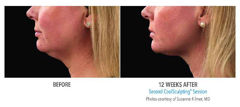 Does CoolSculpting work on saggy neck