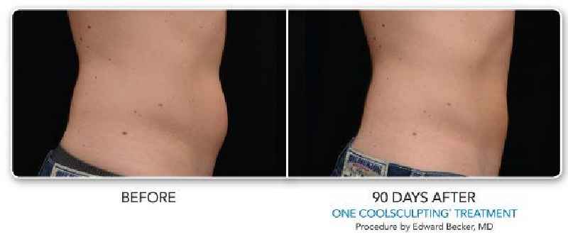 Does CoolSculpting work on stomach
