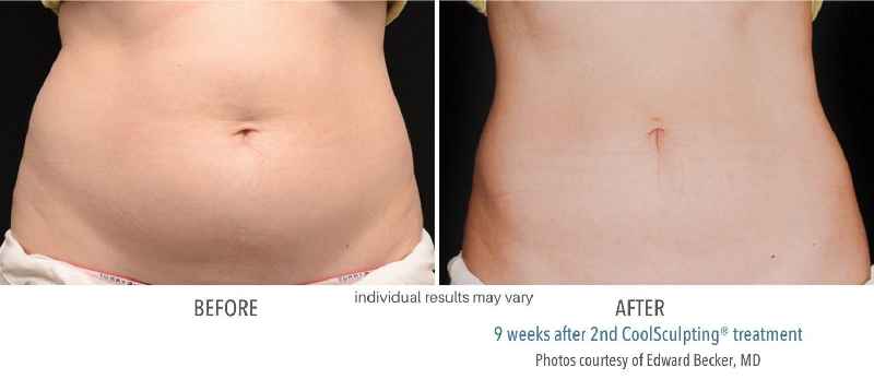Does CoolSculpting work on stubborn belly fat