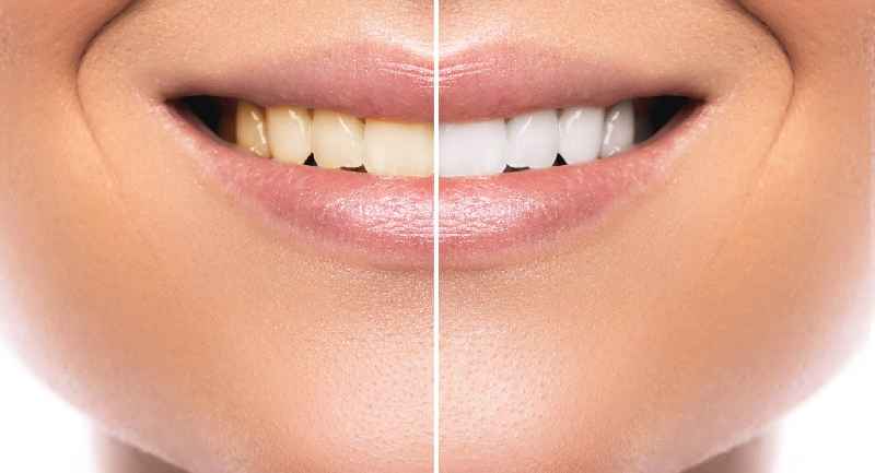 Does cosmetic teeth whitening hurt