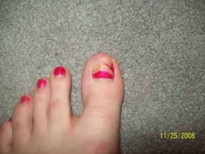 Does cutting nails too short cause ingrown toenails