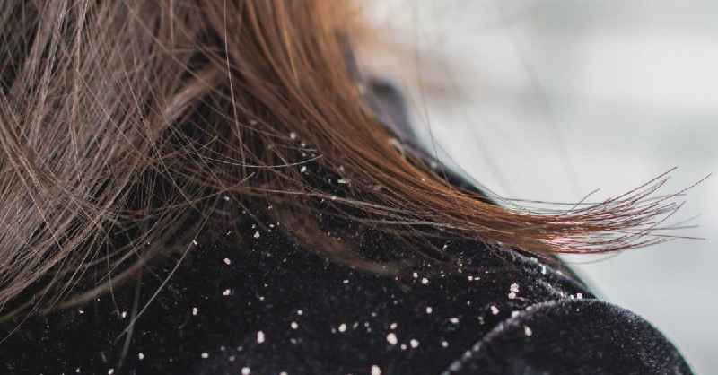 Does dry hair cause hairloss