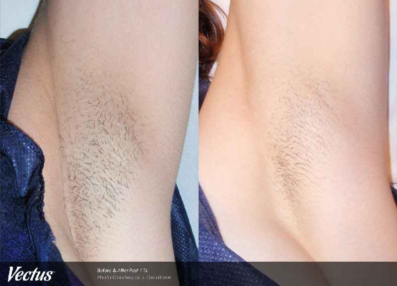 Does electrolysis hair removal hurt