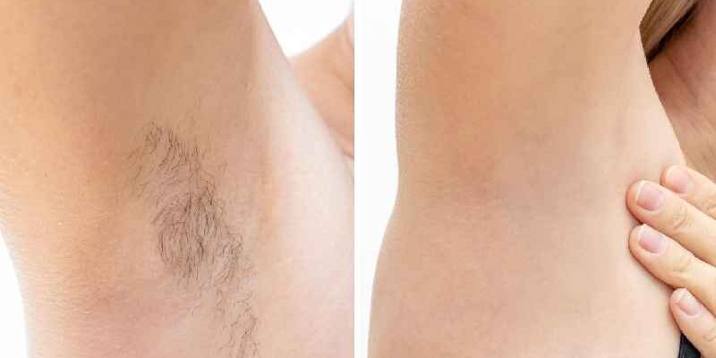 Does electrolysis really work on facial hair