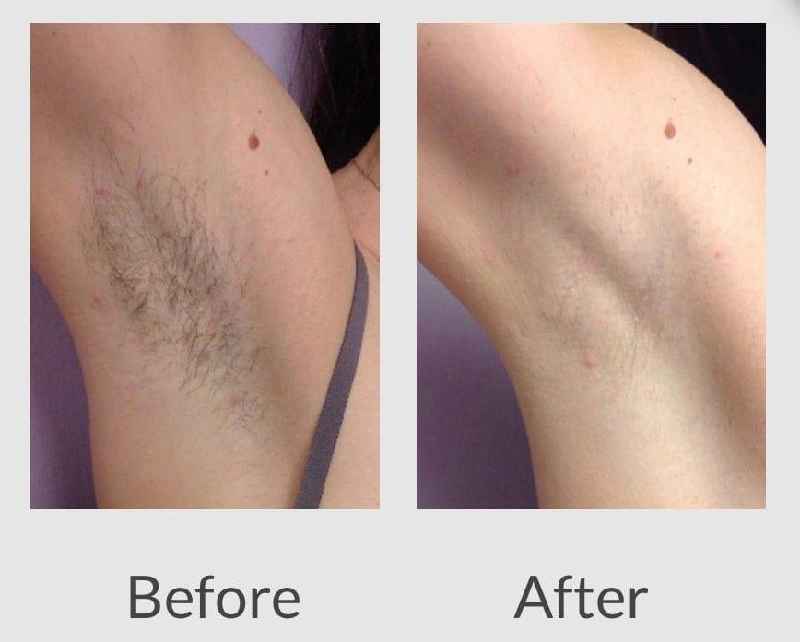 Does hair laser removal last forever