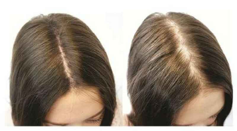 Does hair loss stop at certain age