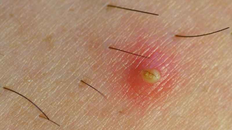 Does hair removal cream cause ingrown hairs