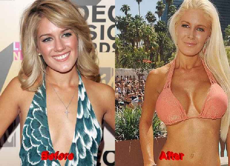 Does Heidi Montag have breast implants