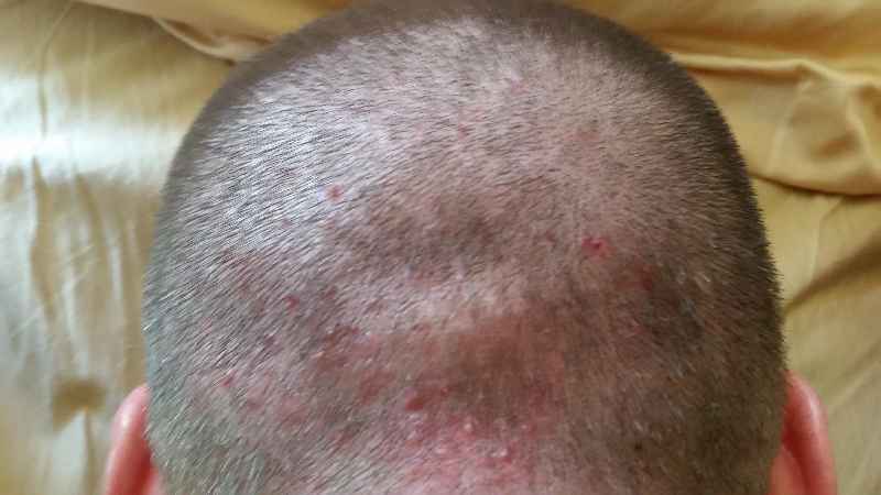 Does high cortisol cause hair loss